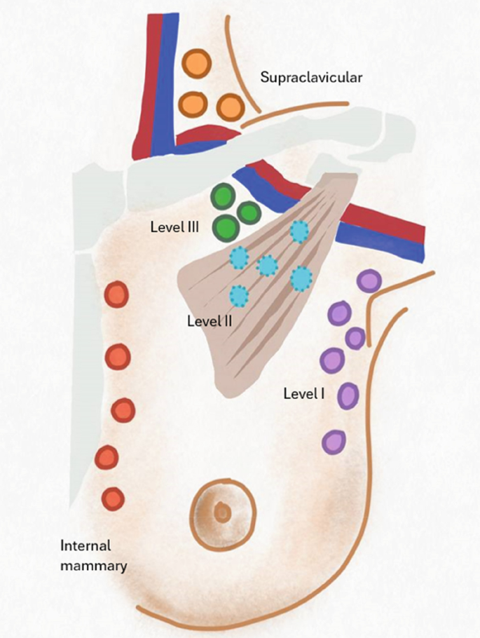 Approach to Imaging of Axilla in Breast Cancer | Springer Nature Link ...