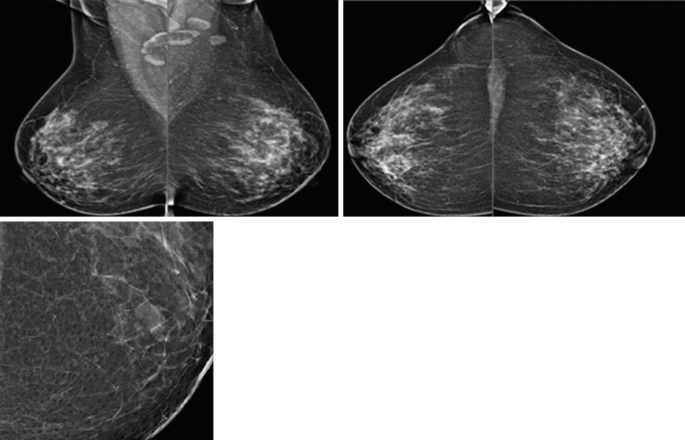 Mammography and Advances | Springer Nature Link