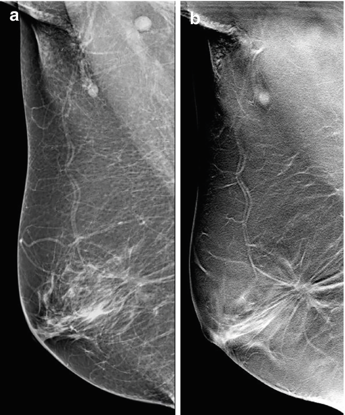 Digital Breast Tomosynthesis and Synthesized Mammogram | Springer ...