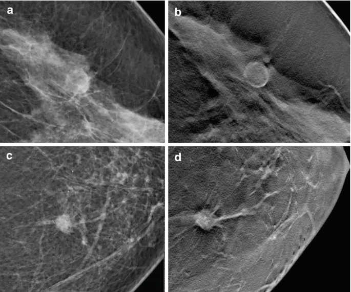Digital Breast Tomosynthesis and Synthesized Mammogram | Springer ...