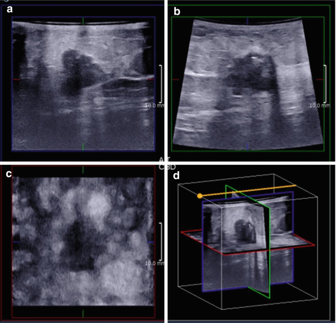 Ultrasound Breast and Its Advancements | Springer Nature Link