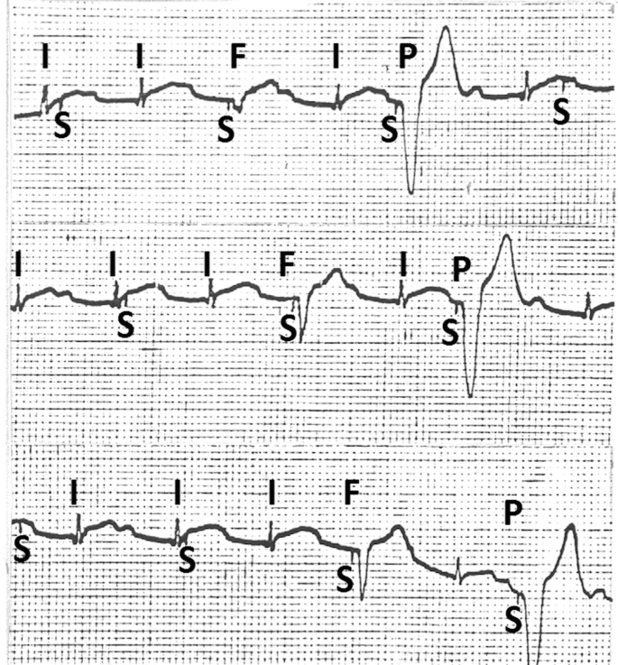 Three sections of the electrocardiogram have an unstable fluctuation where the short upward and downward peaks are labeled as I and S. The starting point of the deep downward peaks are marked as P.