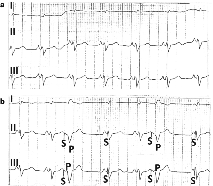 Two sets of electrocardiograms, A and B. Electrocardiograms of lead first, second, and third. The first lead has very less fluctuation, the second lead has moderate fluctuation and the third fluctuation has downward peaks. S is marked in the short downward fluctuation and starting points of downward fluctuations are marked as P.