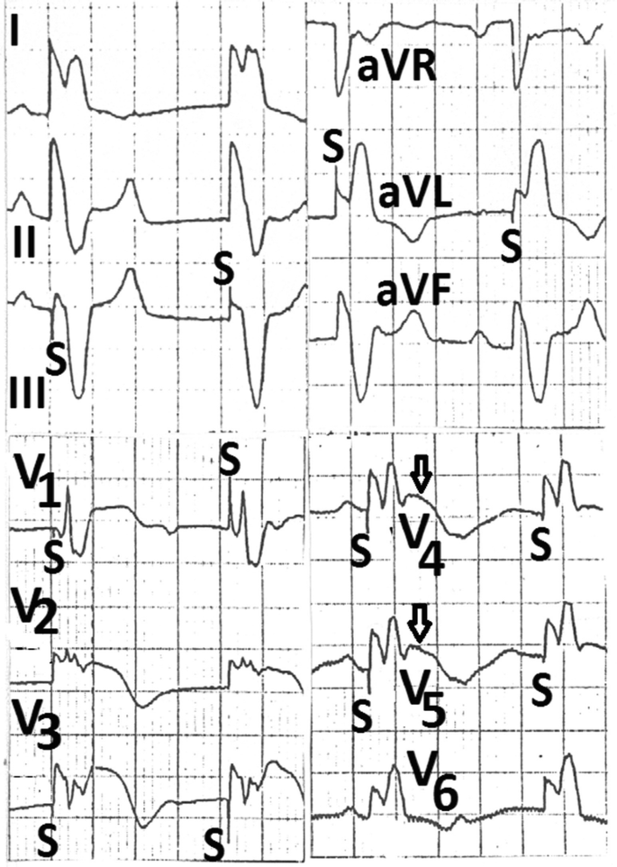Electrocardiograms of lead first, second, third, a V R, a V L, a V F, and V subscript 1 to 6 have unstable fluctuations. An arrow pointing to a blunt peak in V subscripts 4 and 5 and a short downward fluctuation is marked as S.