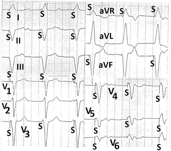 Electrocardiograms of lead first, second, third, a V R, a V L, a V F, and V subscript 1 to 6 have unstable fluctuations. A short downward fluctuation is marked as S.