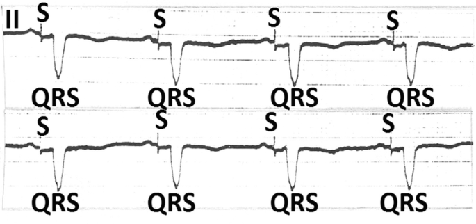 An electrocardiogram of the second lead marks the short upward fluctuation as S and a deep downward peak as Q R S in the fluctuation.