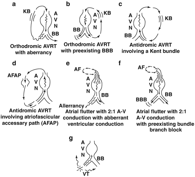 7 illustrations. a and b. orthodromic A V R T with aberrancy and pre-existing B B B. c and d. antidromic A V R T involving K B and A F A P. e and f. atrial flutter with aberrancy and pre-existing B B B. g. involves A V N, B B and V T.