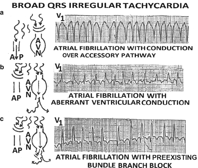 3 waveforms labeled V subscript 1 for 3 types of atrial fibrillation: conduction over the accessory pathway, aberrant ventricular conduction, and preexisting B B B. Their waveforms have a series of tall, uniform peaks, short peaks with highly fluctuating intervals, and tall peaks with minimally varying intervals, respectively.