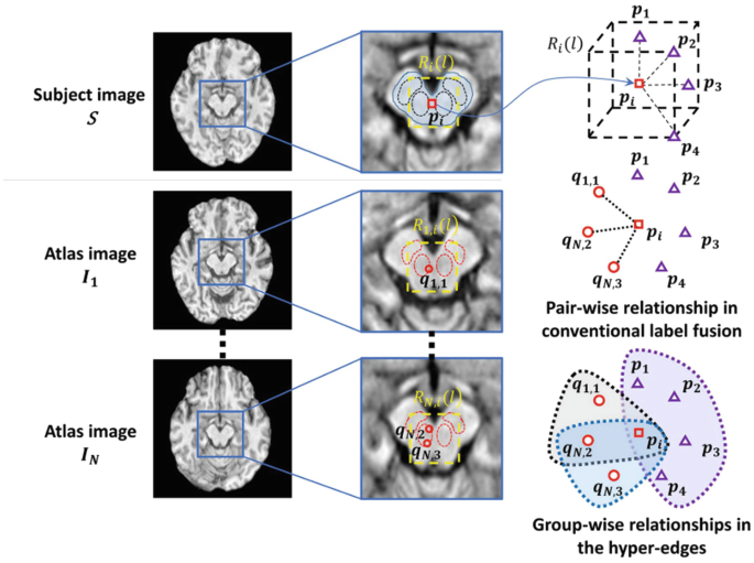 Three medical images of the brain, subject image S, and atlas images I sub 1 to n, with unclear zoomed-in images of central region. There is a 3-D cuboid with central point of p sub i, and labeled vertices, along with pair-wise and group-wise relationship in hyper edges in conventional label fusion.