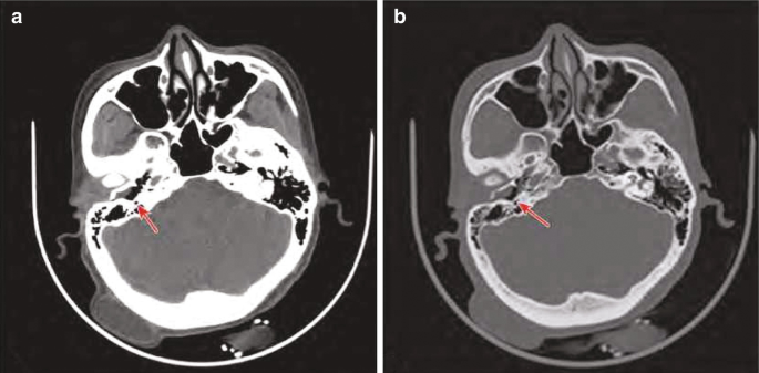 Two C T images of the skull are labeled A and B. Each image has an arrow that points to the affected region in the right external auditory meatus.