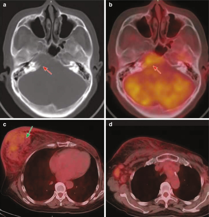 Four scanned images are labeled from A to D. Images A and B have an arrow that points to the affected region in the center. Image C has an arrow that points to the huge mass on the left.