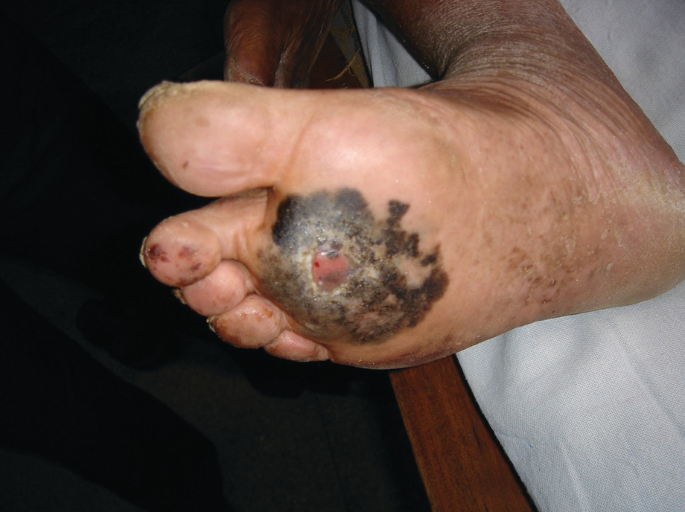 melanotic ulcer Malignant Melanoma