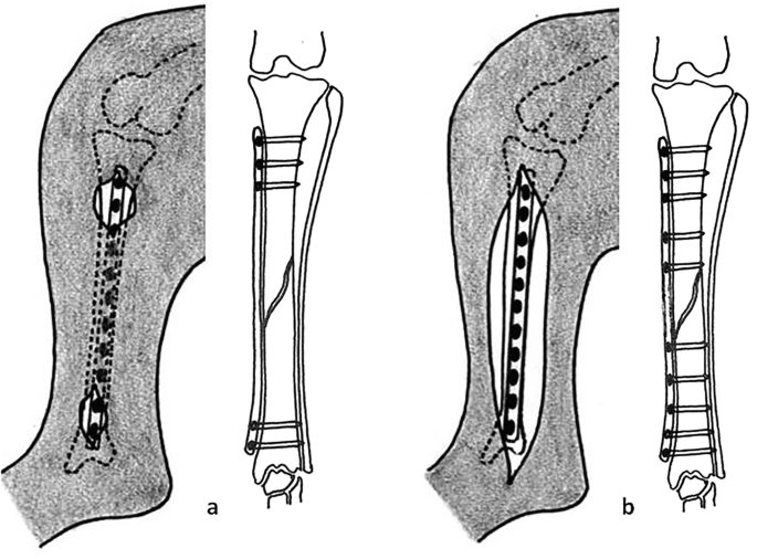 2 illustrations. 1. A small incision is made in the limb and the plate is inserted. The plate is fixed along the fractured bone fragments with the help of screws. 2. A large incision is made in the limb and the plate is inserted. The plate is fixed to the fragments with the help of screws.