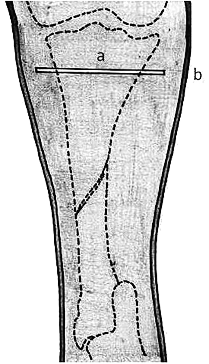 A diagram of a limb with a fractured bone. A Steinmann pin is inserted horizontally through the upper bone fragment. A cast is applied around the limb.