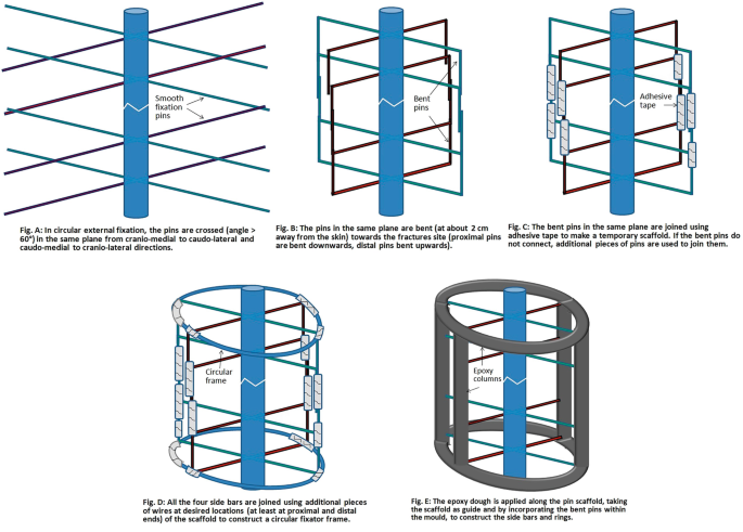 Fixation of ring fixator to proximal tibia. (a) Transverse wire