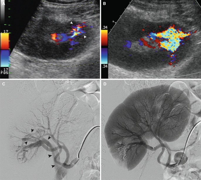 Renal Trauma | Springer Nature Link