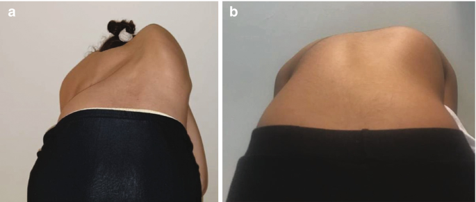Rib Hump | SpringerLink