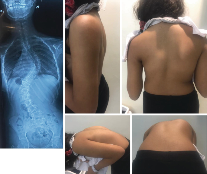 Rib Hump | SpringerLink