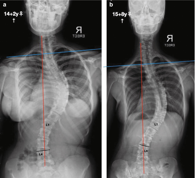 Lenke Classification of Scoliosis and Its Application | SpringerLink