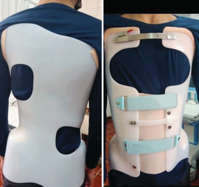 Orthotic Management in Adolescent Idiopathic Scoliosis (AIS