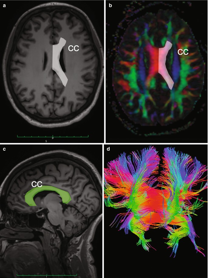 4 illustrations. 1 and 2. A M R I scan and a F A map of the brain marks the corpus callosum. 3. Corpus callosum is marked in the sagittal M R I scan. 4. A tractography scan of the corpus callosum.