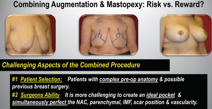 Combined Mastopexy and Breast Augmentation