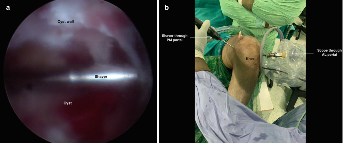 The image consists of two parts. a. An endoscopic view of the knee joint and the shaver is inserted into the dark cyst. b. A photo of the patient's knee joint inserted by the shaver through the P M portal.