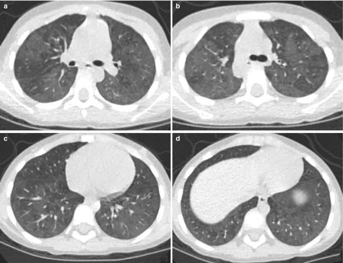 4 C T scans of the lungs reveal cloudy areas all around. There are also tiny bumps in the middle of the lung sections. Some parts of the lung seem a bit thicker.