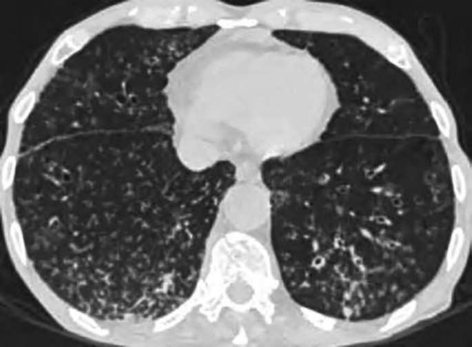 A C T scan of the lung reveals that there are lots of small bumps in both lungs. Some of these bumps look solid, like tiny lumps, and some are a bit cloudy, like mist. Also, the tubes in the lungs, called bronchial walls, look thicker than usual.