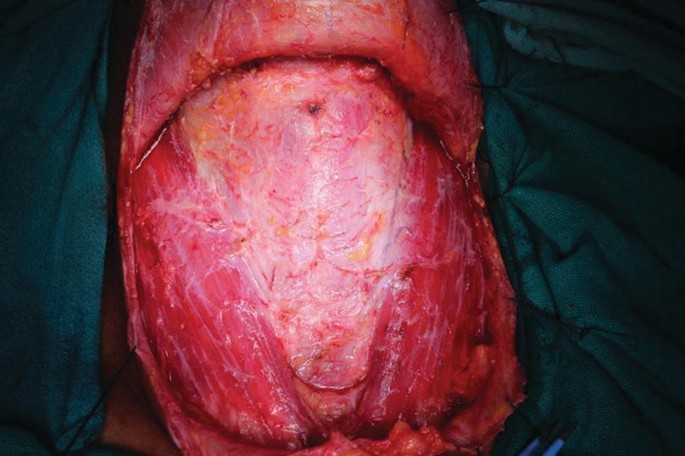 An intraoperative photo of the dissected neck region of the patient with exposed skin flaps.