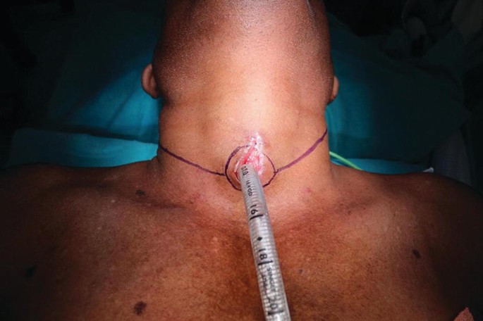 An intraoperative photo of the incision on the patient's neck exhibits the insertion of the tube through an opening in the larynx region. The region is marked.