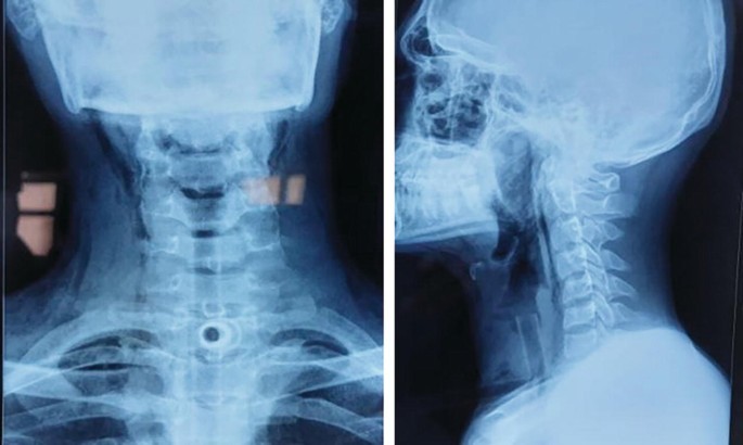 Two X-rays of the thoracic region of the patient in the anteroposterior and lateral views. They exhibit the T-tube in the tracheostoma.