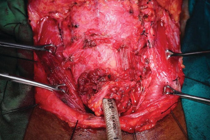 An intraoperative photo exhibits the insertion of the tube through the larynx and forceps holding the skin flaps on the sternocleidomastoid muscles on both sides.