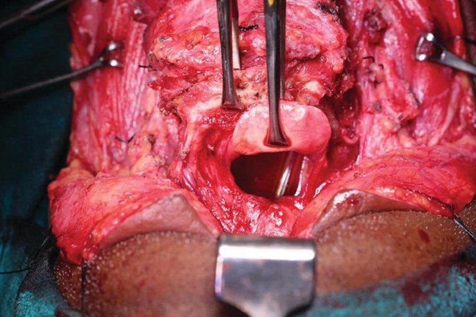 An intraoperative photo exhibits that the pharynx region is stretched, and surgical forceps are used to hold the skin flaps on the vallecula region.