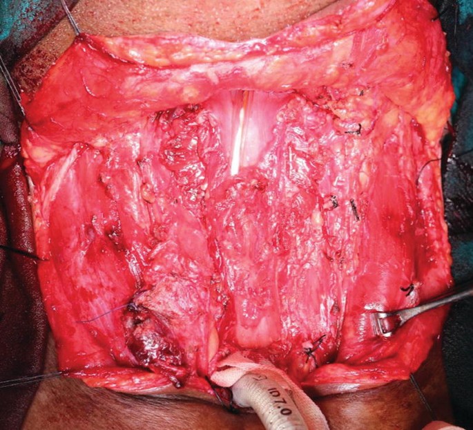 An intraoperative photo of the dissected neck region exhibits the tube insertion through an opening in the larynx, with surgical forceps holding the skin flaps on the right.