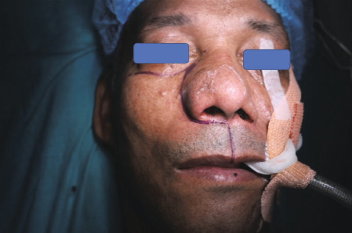 A photo of the face of an intubated individual. Incision marks are made on the face vertically above the upper lip.