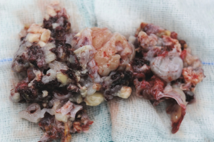 A photo of a surgically removed tumor. The tumor has light-shaded patches and blood clots on its surface.