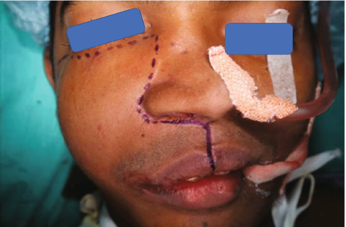 A photo of an intubated individual. An incision is marked at the base of the right eye, extending it downwards to the side of the nose towards the upper lip.