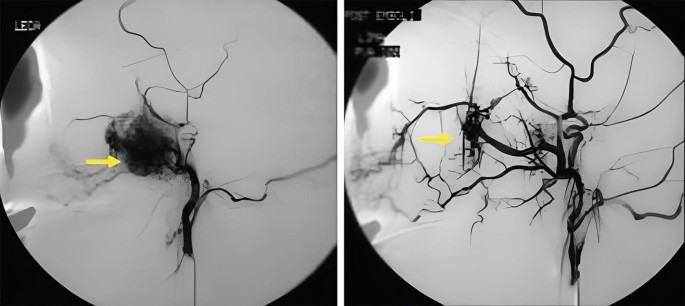 2 D S A scans of a blood vessel network. 1. A dense and darker shaded region is present in the blood vessel. 2. The dense and darker shaded region is absent. The densely shaded region indicates the presence of a tumor.