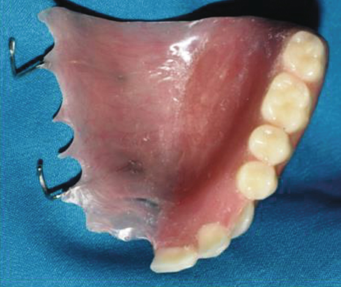 A photo of the bottom view of a dental obturator. It consists of mold with gums and prosthetic teeth.