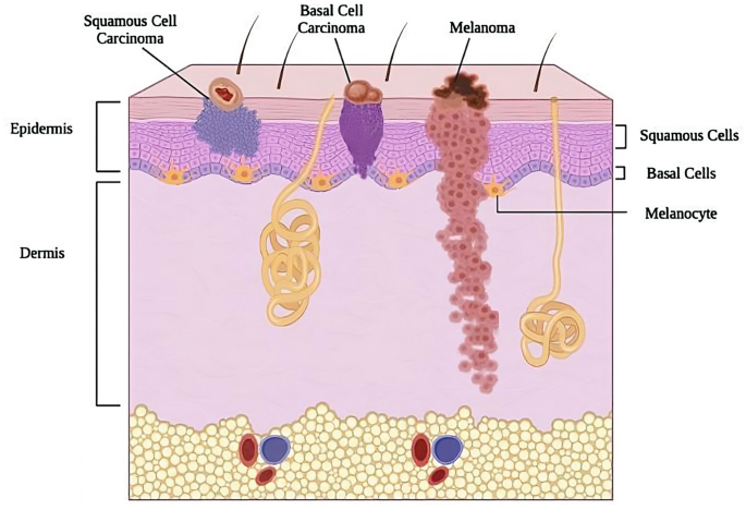Skin Cancer: An Overview