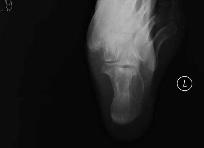 Ankle & hindfoot | Radiology Key
