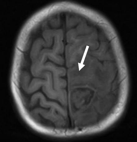 An M R I of the brain in the axial plane. On the left hemisphere, there is a dense and dark-shaded opacity. This indicates the presence of inflammation and fluid accumulation in the brain.