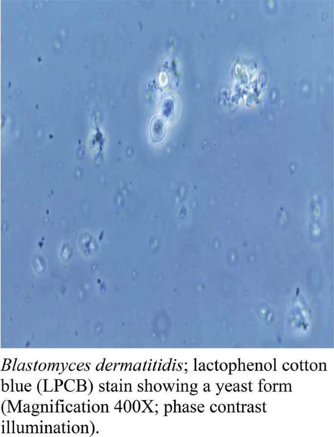 Role of Dimorphic Fungi in CNS Infections | SpringerLink role-of-dimorphic-fungi-in-cns-infections-springerlink