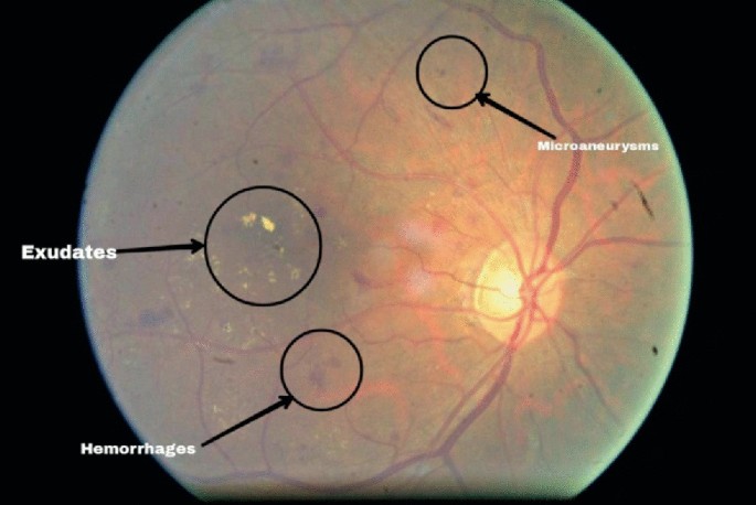 A photograph of a diabetic retinopathy fundus eye. Arrows mark leaky blood vessels, dot-like hemorrhages, and small bright patches of exudates.