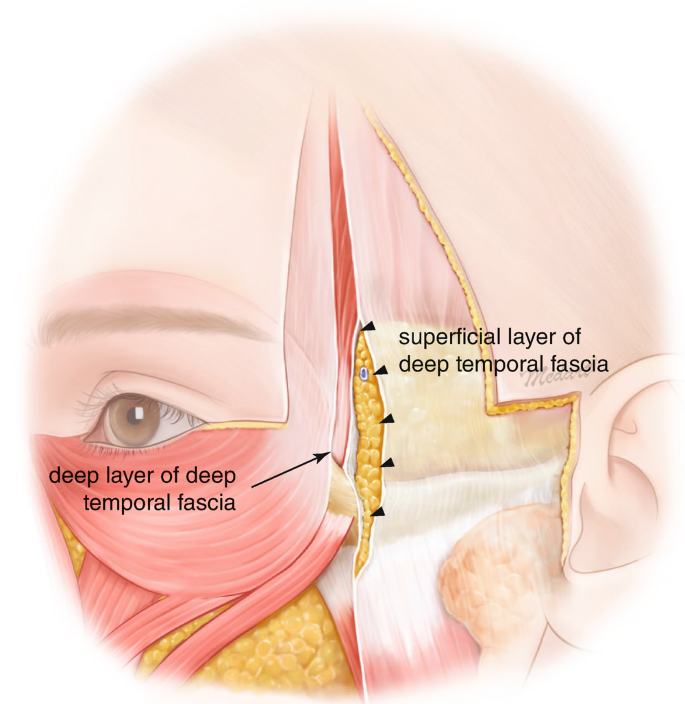 Clinical Anatomy of the Upper Face for Filler Injection | SpringerLink