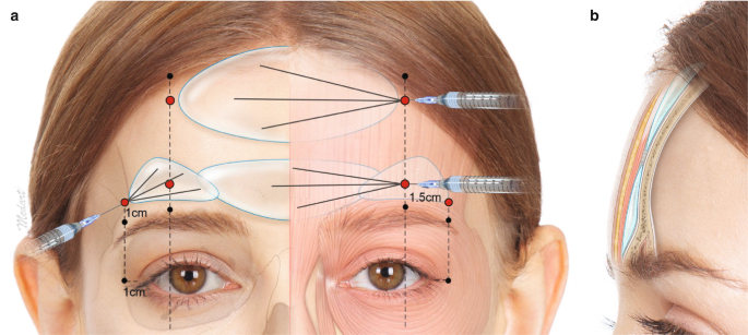 Clinical Anatomy of the Upper Face for Filler Injection | SpringerLink