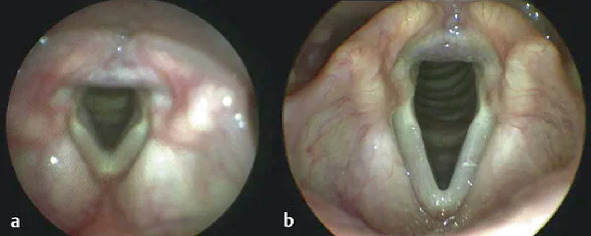 2 endoscopic images of the larynx present a triangular shaped hollow structure surrounded by flesh. The shape in part A, is small while in part B, the conical part of the triangular shape is elongated.