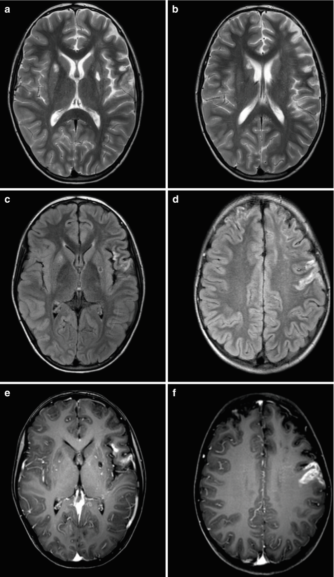 Vascular Neurosurgery - Cerebro-vascular Malformations and Neurocritical  Care | Springer Nature Link (formerly SpringerLink)