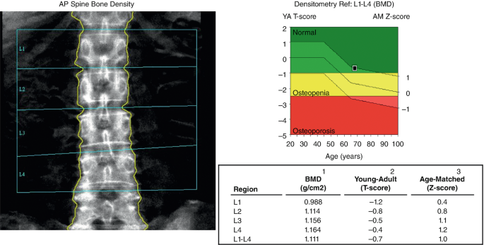 Parameter Selection for Correct Diagnosis on DXA | Springer Nature Link